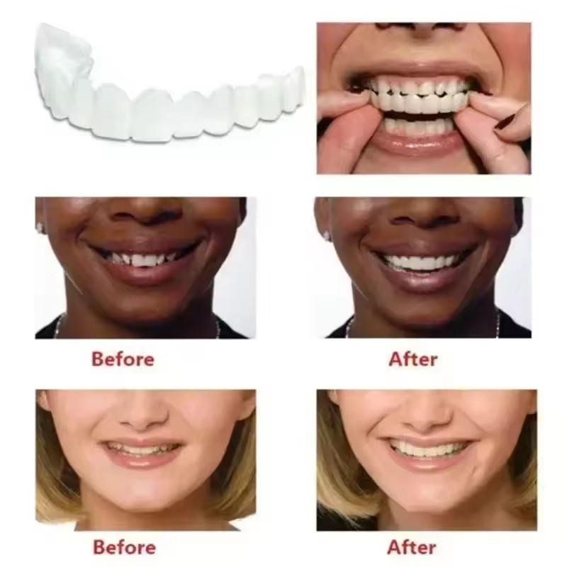 Teeth Veneers Whitening Dentur - Teeth Whitening For Braces avaliação e preço