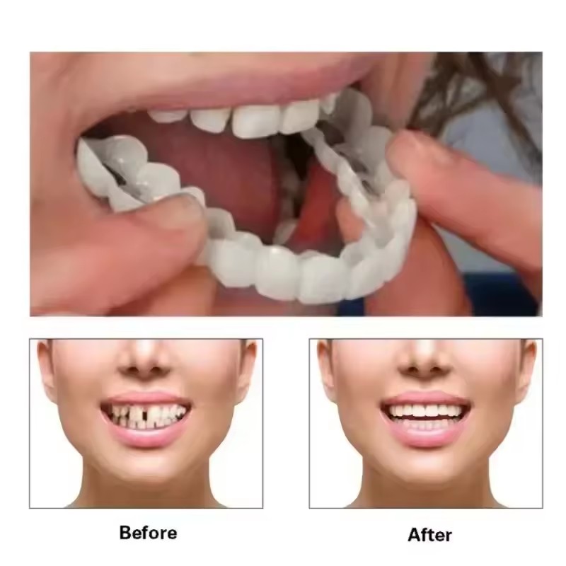Teeth Veneers Whitening Dentur - Teeth Whitening For Braces avaliação e preço