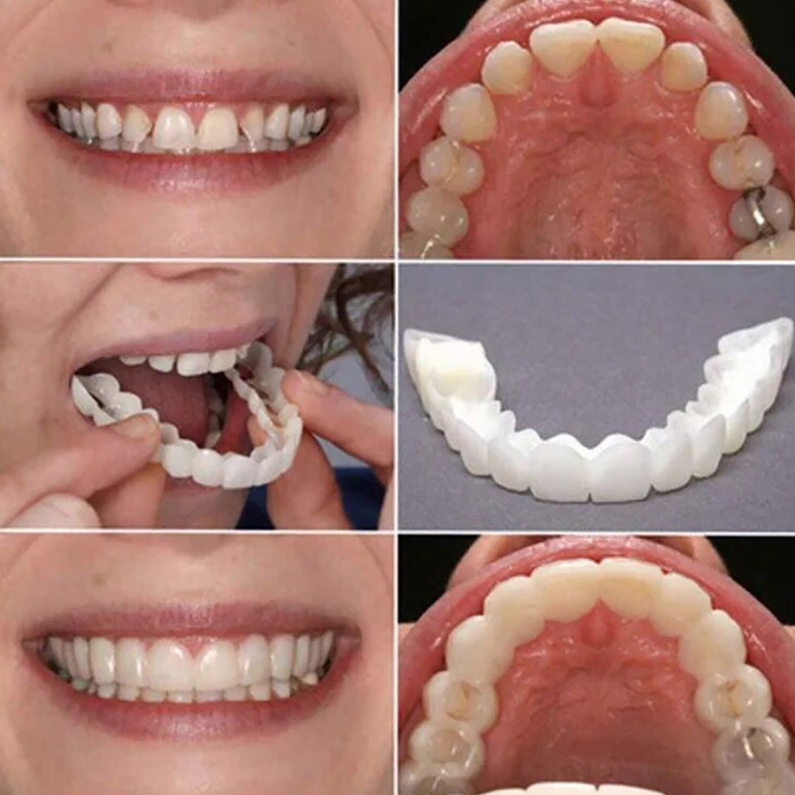 Hot Teeth Veneers Whitening De - Teeth Whitening For Braces avaliação e preço