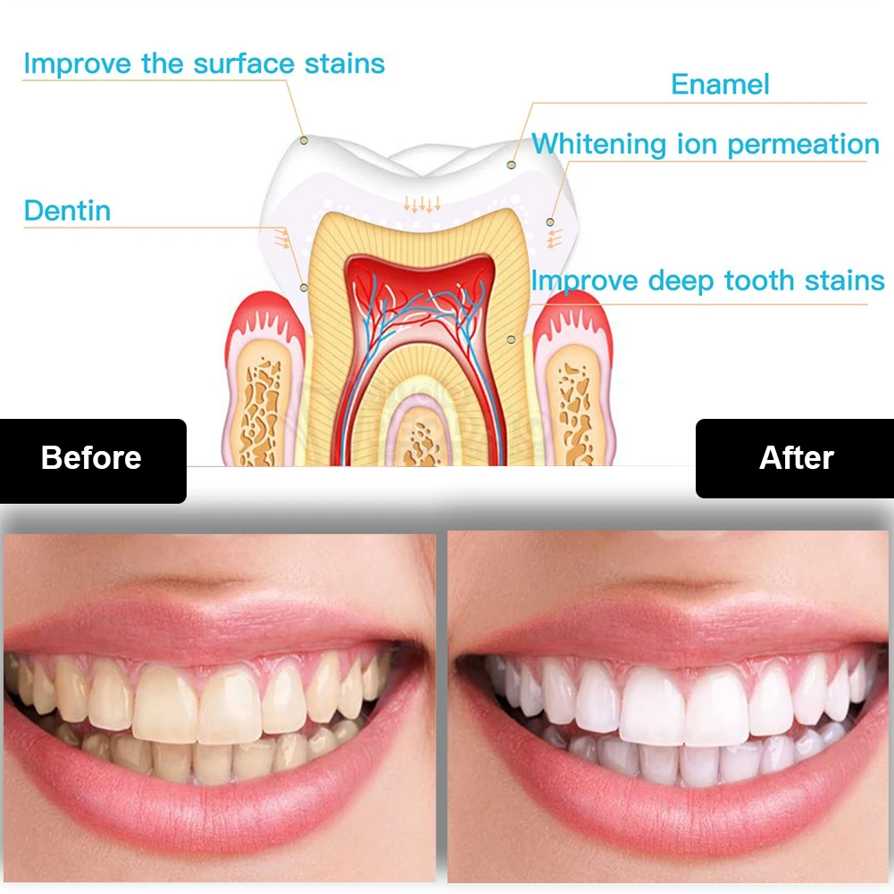 Dental Teeth Whitening Kit Min - Teeth Whitening App avaliação e preço