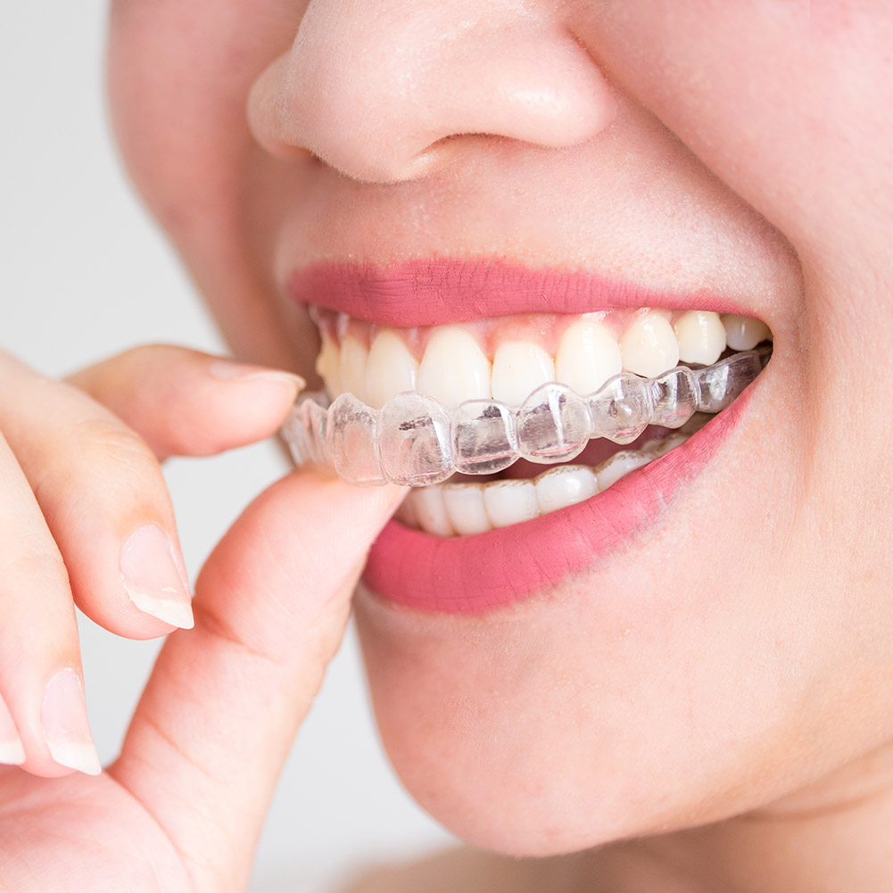 2/4pcs Mouth Guard Teeth Prote - Teeth Whitening With Trays avaliação e preço